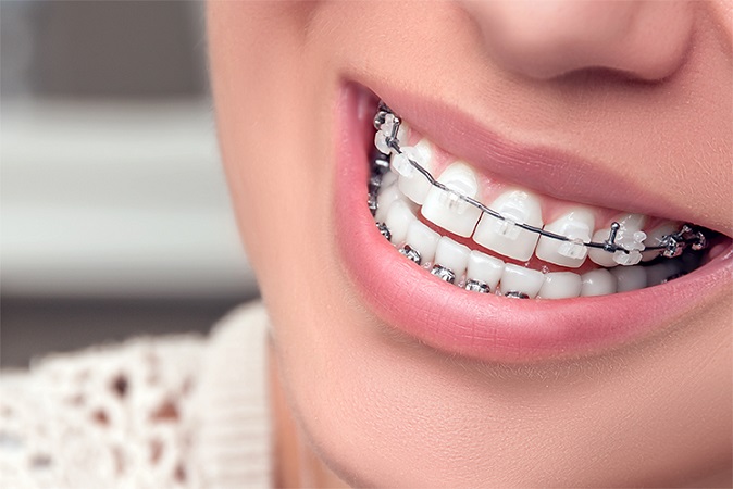 ارتودنسی سرامیکی چه مزایایی برای دهان و دندان دارد