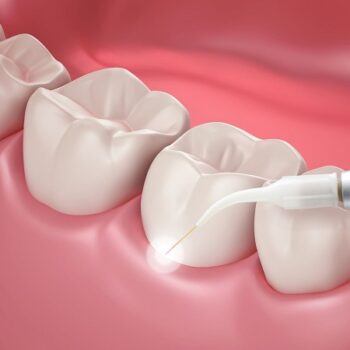 درمان پوسیدگی دندان با لیزر چگونه انجام میشود