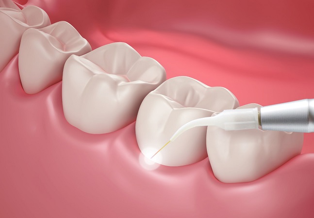 درمان پوسیدگی دندان با لیزر چگونه انجام میشود
