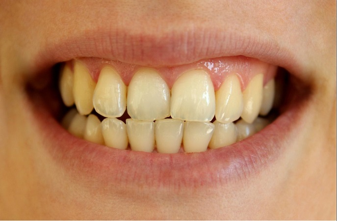زرد شدن دندان دارای چه علائمی است