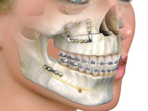روش های درمان آندربایت دندان کدامند