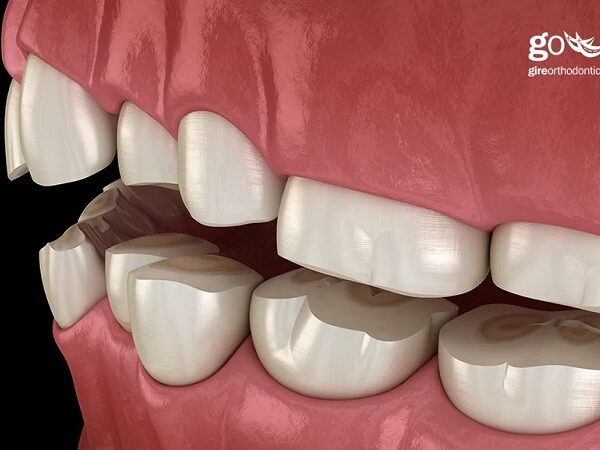 ماملون ها بیشتر در کدام دندان ها بوجود می آیند