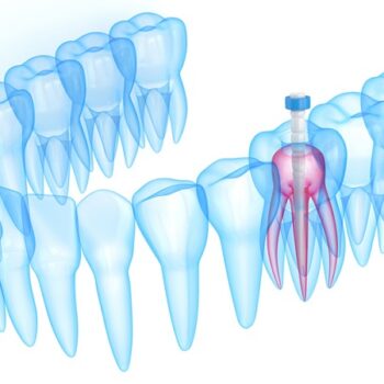 بیلداپ یا بازسازی دندان چه مزایایی دارد