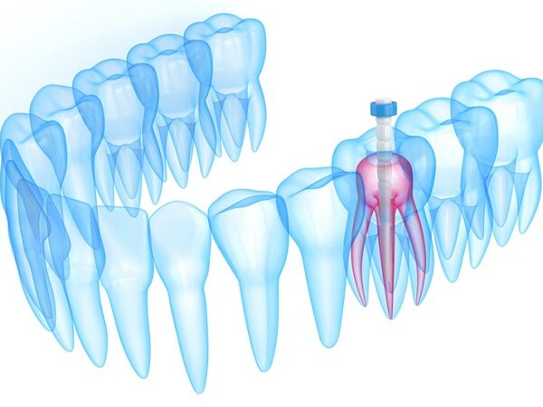 بیلداپ یا بازسازی دندان چه مزایایی دارد