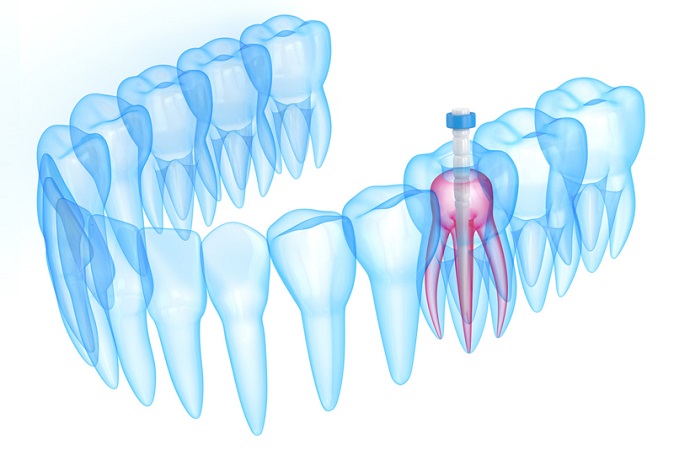 بیلداپ یا بازسازی دندان چه مزایایی دارد
