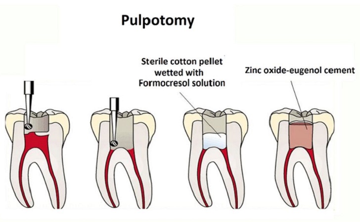 پالپوتومی دندان چه مزایایی دارد